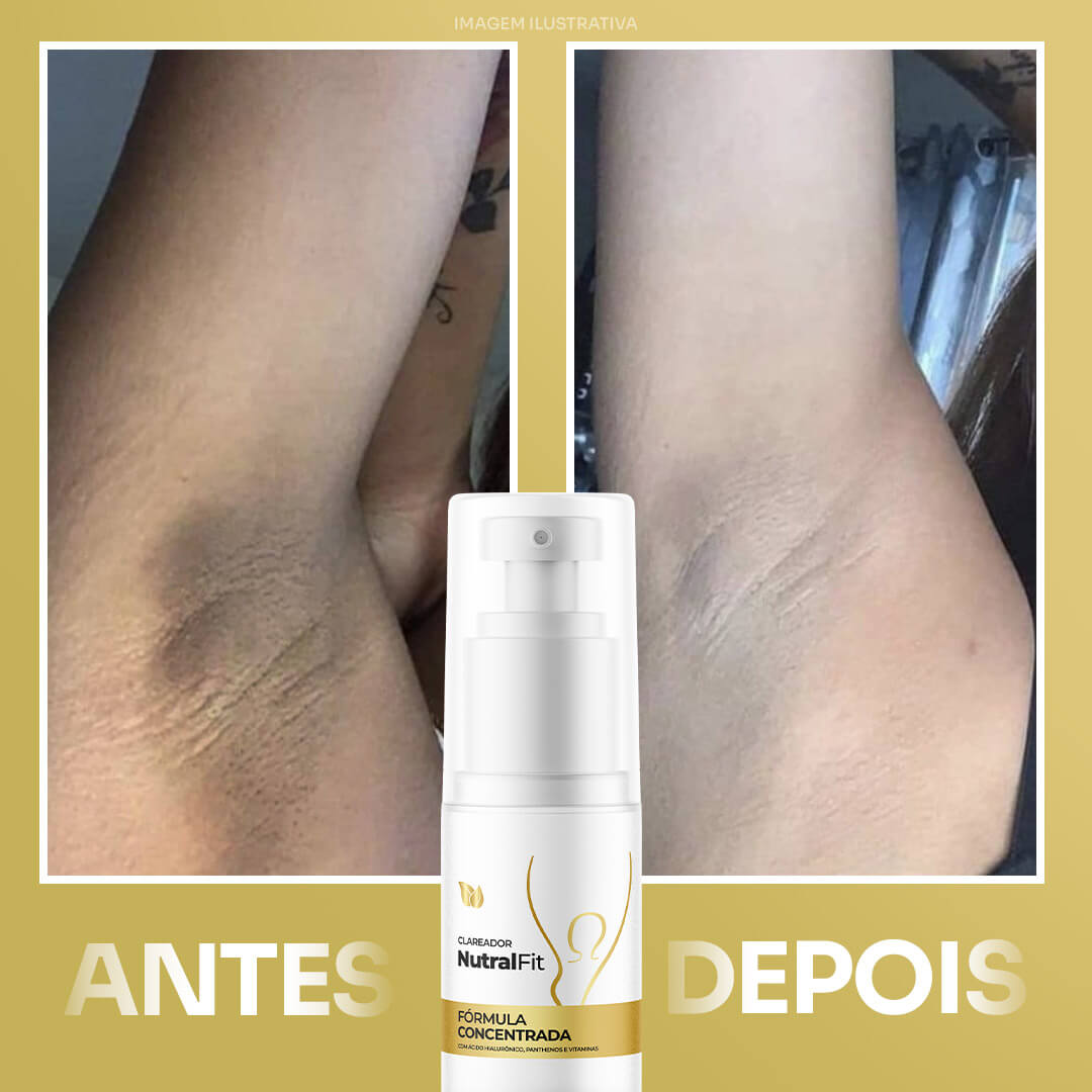 Antes e Depois - Redução de hiperpigmentação com NutralFit (Imagem 3)